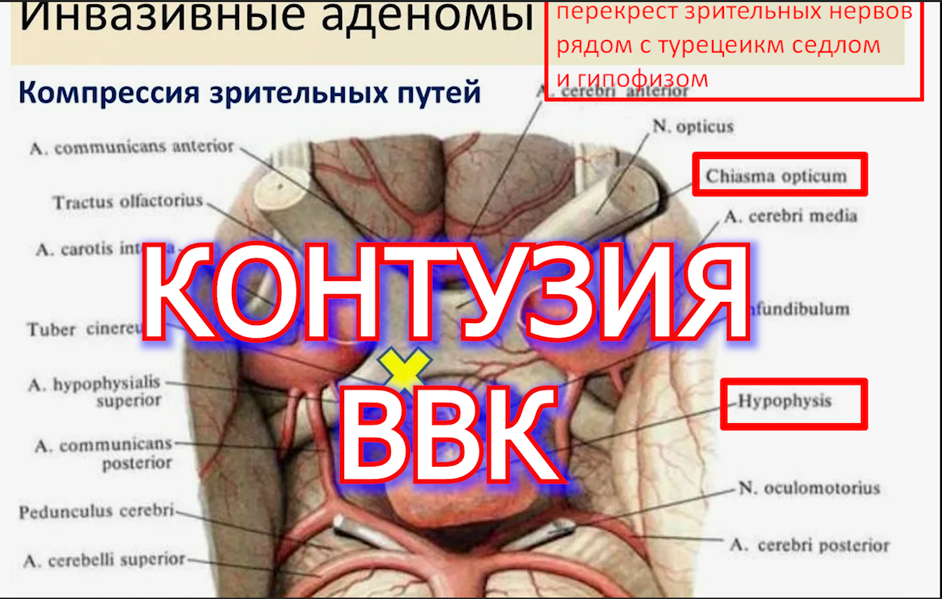 Контузия - последствия-спор с ВВК ч.1 voenset.ru  
