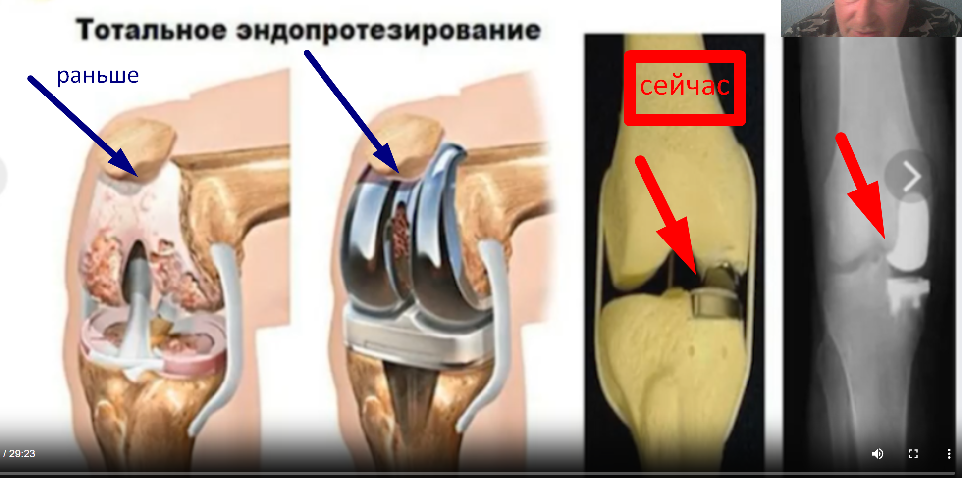Травма колена СВО- расследование травмы  подготовка к суду с ВВК voenset.ru 