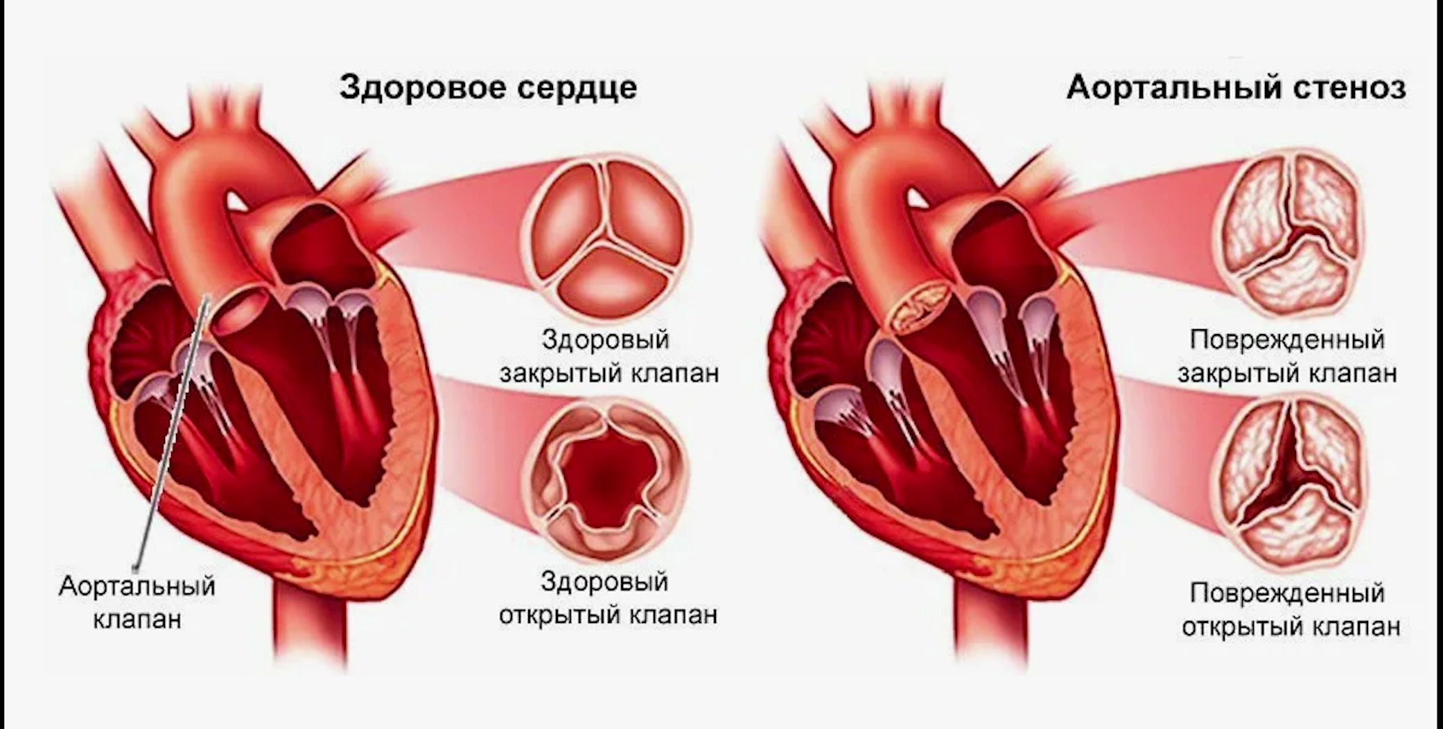 порок серца - увольнение 2 часть консультации  voenset.ru 1